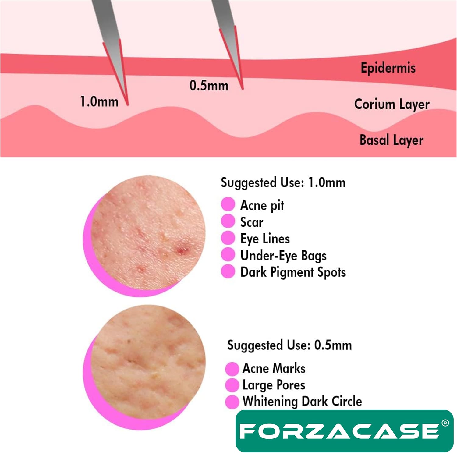 Forzacase%20Dermaroller%201.00%20mm%20540%20İğneli%20Masaj%20Aleti%20Saç%20Skin%20Cilt%20Tarağı%20%20-%20FC838